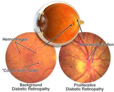 Eyesight Risk for Diabetic Patients