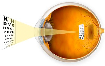 Nearsightedness - Myopia Vision Impairment - Bellville, Columbus, Austin County, Texas